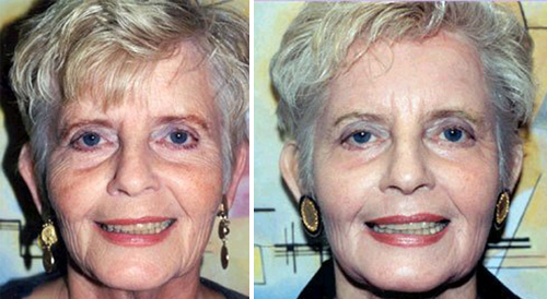 Laser Resurfacing Before & After Pictures Laser Resurfacing Before & After Pictures