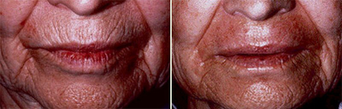 Laser Resurfacing to Reduce Wrinkles Around the Mouth Laser Resurfacing to Reduce Wrinkles Around the Mouth