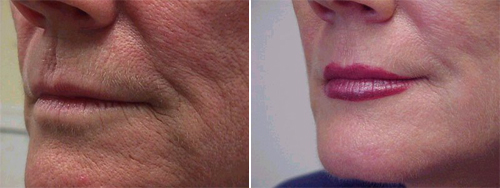 Erbium: YAG Laser in Combination with the CO2 Laser Erbium: YAG Laser in Combination with the CO2 Laser
