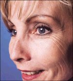 botox_1a_small.jpg 150x166
