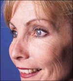 botox_1b_small.jpg 150x166