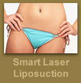 smart laser liposuction