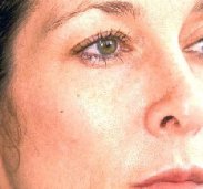 dermalive_i5a.jpg 233x218