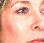 dermalive_i5b.jpg 228x223